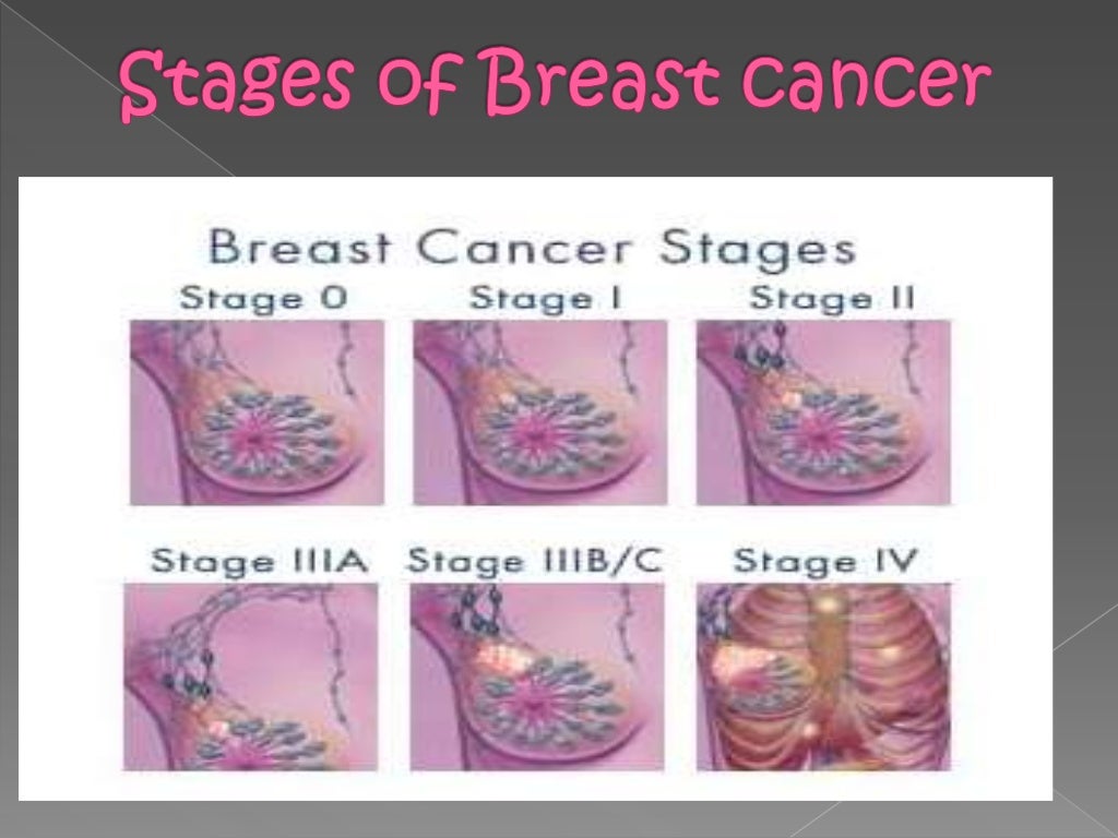 movable lump in breast movable lump in breast