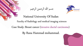 Case Study: Breast cancer (invasive ductal carcinoma)
By Rana Hammad mohammad.
 
