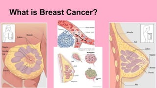 What is Breast Cancer? 
 