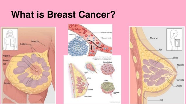 Image result for What Is Breast Cancer?