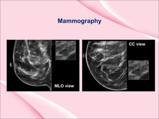 Mammography
•
 