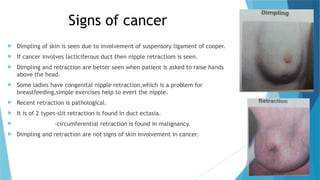 BREAST CANCER & SINGLE STOP BREAST CLINIC.pptx