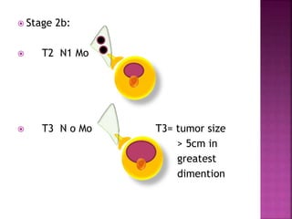  Stage 2b:
 T2 N1 Mo
 T3 N o Mo T3= tumor size
> 5cm in
greatest
dimention
 
