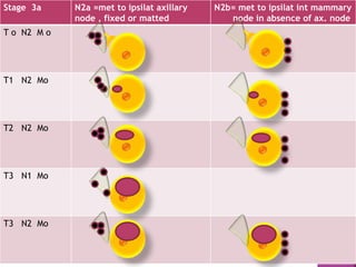 Stage 3a N2a =met to ipsilat axillary
node , fixed or matted
N2b= met to ipsilat int mammary
node in absence of ax. node
T o N2 M o
T1 N2 Mo
T2 N2 Mo
T3 N1 Mo
T3 N2 Mo
 