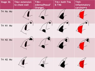 Stage 3b T4a= extension
to chest wall
T4b=
edema(Peaud’
Orange),
T4c= both T4a
& T4b
T4d=
inflammatory
carcinoma
T4 No Mo
T4 N1 Mo
T4 N2 Mo
T4 N2 Mo
 