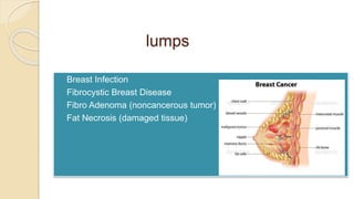 lumps
 Breast Infection
 Fibrocystic Breast Disease
 Fibro Adenoma (noncancerous tumor)
 Fat Necrosis (damaged tissue)
 