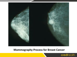 Mammography Process for Breast Cancer
 