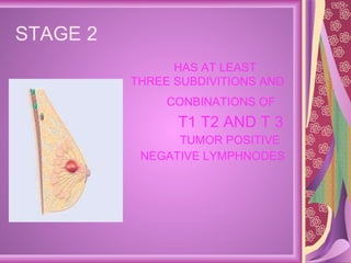 STAGE 2  HAS AT LEAST THREE SUBDIVITIONS AND CONBINATIONS OF   T1 T2 AND T 3  TUMOR POSITIVE  NEGATIVE LYMPHNODES 