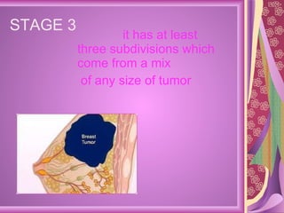 STAGE 3  it has at least three subdivisions which  come from a mix  of any size of tumor  