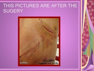 THIS PICTURES ARE AFTER THE SUGERY  