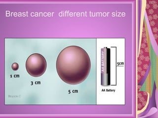 Breast cancer  different tumor size 