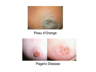 Paget’s Disease
Peau d’Orange
 