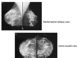 Medial-lateral oblique view
cranio-caudal view
 
