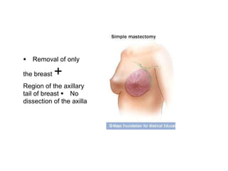 " Removal of only
the breast +
Region of the axillary
tail of breast " No
dissection of the axilla
 