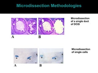 Microdissection
of a single duct
of DCIS
Microdissection
of single cells
Microdissection Methodologies
 