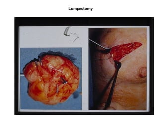 Lumpectomy
 