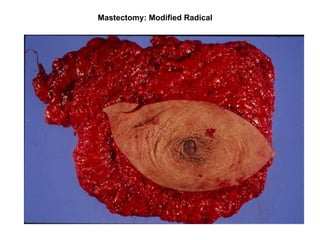 Mastectomy: Modified Radical
 