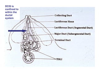DCIS is
confined to
within the
ductal
system
 