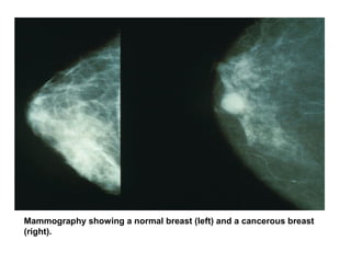 Mammography showing a normal breast (left) and a cancerous breast
(right).
 