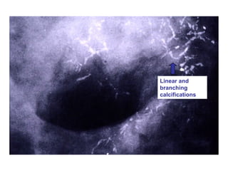 Linear and
branching
calcifications
 