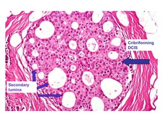 Cribriforming
DCIS
Secondary
lumina
 