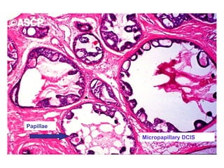 Micropapillary DCIS
Papillae
 