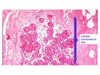 Lobular
carcinoma in
situ
 
