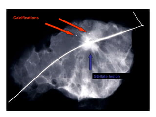 Stellate lesion
Calcifications
 