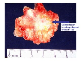 Stellate lesion
invading adjacent
breast tissue
 