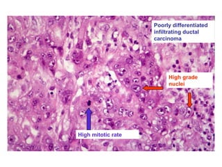 Poorly differentiated
infiltrating ductal
carcinoma
High grade
nuclei
High mitotic rate
 
