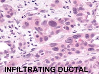 INFILTRATING DUCTAL
 