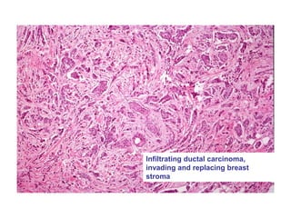 Infiltrating ductal carcinoma,
invading and replacing breast
stroma
 