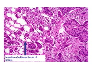 Invasion of adipose tissue of
breast
 