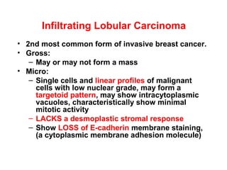 Infiltrating Lobular Carcinoma
• 2nd most common form of invasive breast cancer.
• Gross:
– May or may not form a mass
• Micro:
– Single cells and linear profiles of malignant
cells with low nuclear grade, may form a
targetoid pattern, may show intracytoplasmic
vacuoles, characteristically show minimal
mitotic activity
– LACKS a desmoplastic stromal response
– Show LOSS of E-cadherin membrane staining,
(a cytoplasmic membrane adhesion molecule)
 