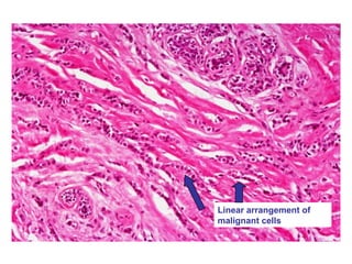 Linear arrangement of
malignant cells
 