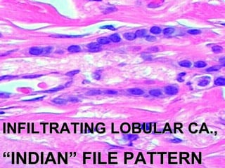 INFILTRATING LOBULAR CA.,INFILTRATING LOBULAR CA.,
““INDIAN” FILE PATTERNINDIAN” FILE PATTERN
 