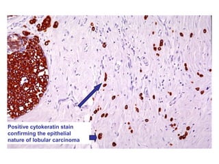 Positive cytokeratin stain
confirming the epithelial
nature of lobular carcinoma
 