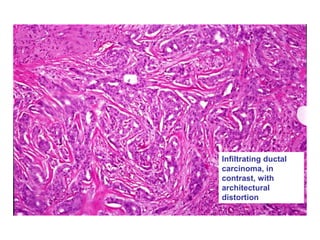 Infiltrating ductal
carcinoma, in
contrast, with
architectural
distortion
 