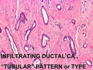 INFILTRATING DUCTAL CA.,INFILTRATING DUCTAL CA.,
““TUBULAR” PATTERN or TYPETUBULAR” PATTERN or TYPE
 
