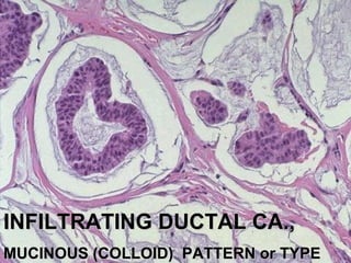 INFILTRATING DUCTAL CA.,INFILTRATING DUCTAL CA.,
MUCINOUS (COLLOID) PATTERN or TYPEMUCINOUS (COLLOID) PATTERN or TYPE
 