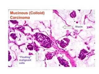Mucinous (Colloid)
Carcinoma
 