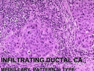 INFILTRATING DUCTAL CA.,INFILTRATING DUCTAL CA.,
 