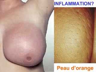 INFLAMMATION?
Peau d’orange
 