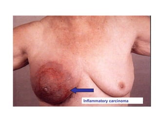 Inflammatory carcinoma
 