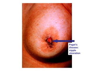 Paget’s
disease:
nipple
ulceration
 