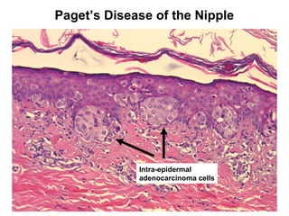Paget’s Disease of the Nipple
Intra-epidermal
adenocarcinoma cells
 