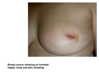 Breast cancer showing an inverted
nipple, lump and skin dimpling.
 