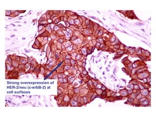 Strong overexpression of
HER-2/neu (c-erbB-2) at
cell surfaces
 