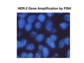 HER-2 Gene Amplification by FISH
 