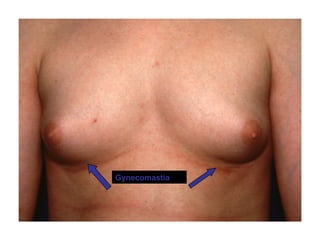 Gynecomastia
 